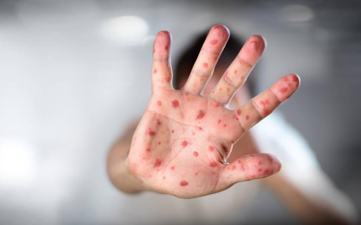 Κόσμος: Νεκρά εκατοντάδες παιδιά από επιδημία ιλαράς γιατί δεν είχαν εμβολιαστεί