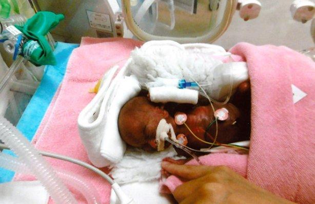 Ιατρικό θαύμα στην Ιαπωνία: Αγοράκι γεννήθηκε 258 γραμμάρια και έζησε
