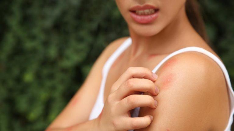 Δερματολόγος εξηγεί τους 4 λόγους για τους οποίους σας τσιμπάνε τα κουνούπια -Η ομάδα αίματος που προτιμούν